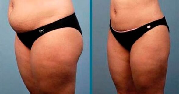 metoder för att gå ner i vikt med 10 kg på en månad